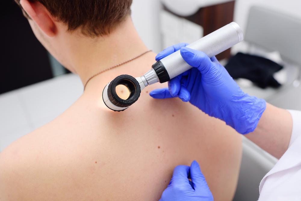 Use the ABCDE Method to Check Your Moles Diagnosis and Treatment in
